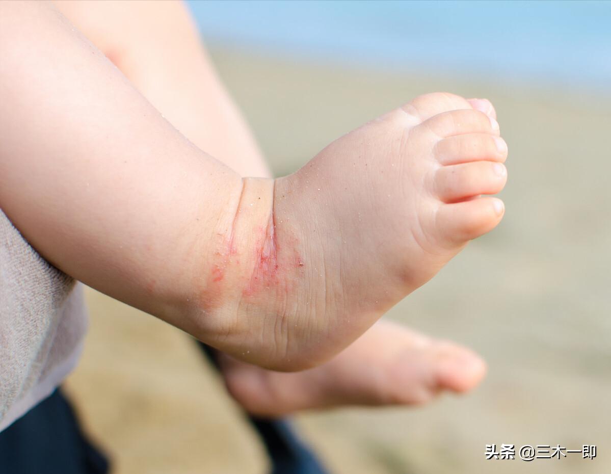 湿疹怎样做好日常预防护理,儿童湿疹反复发作三招教你搞定