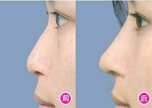 鼻梁高但不精致如何调整,塌鼻梁如何拯救侧颜