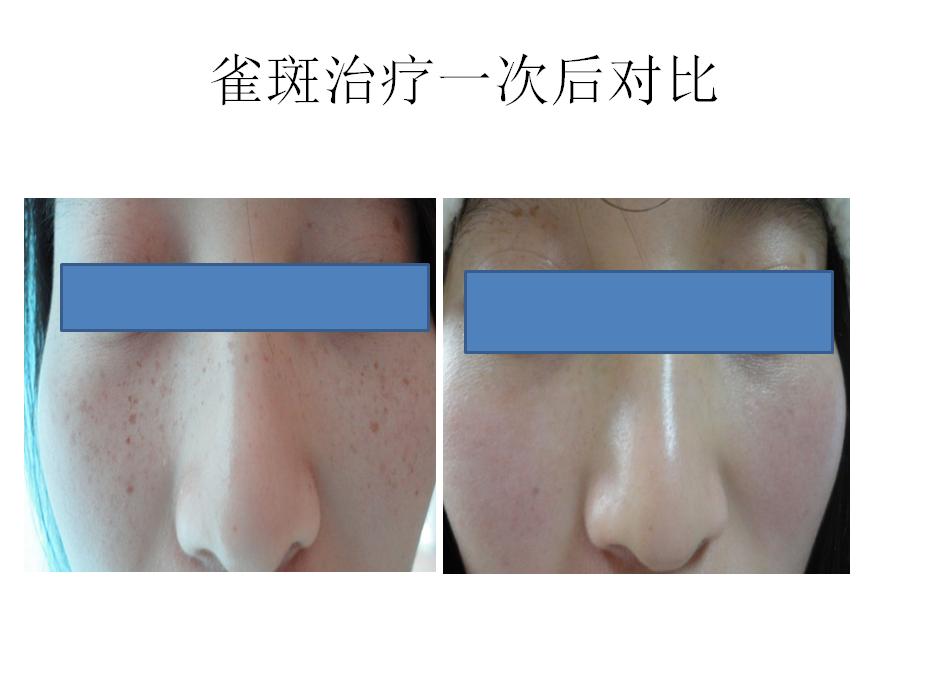 超皮秒华美,超皮秒专场直播