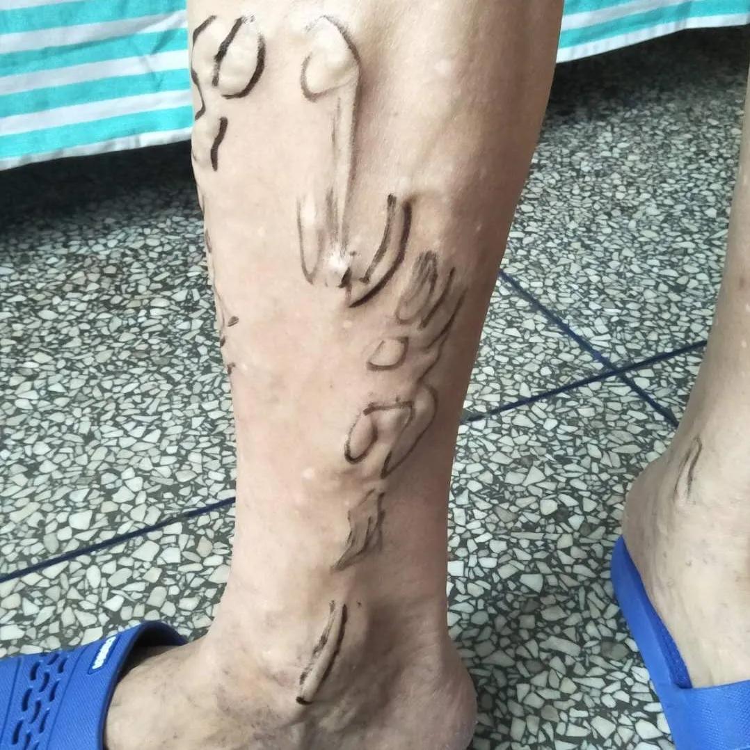 河北静脉曲张微创手术,邢台静脉曲张手术多长时间治好