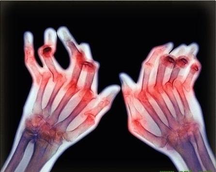 类风湿造成的关节变形可恢复吗？大多不行，有两种情况可以