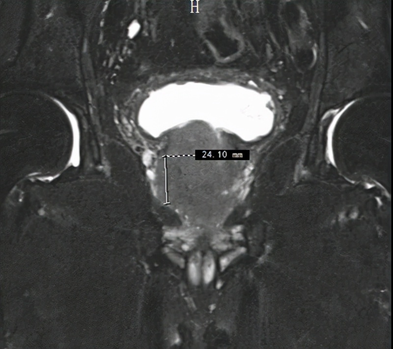 泌尿外科专家前列腺癌,前列腺癌高危癌