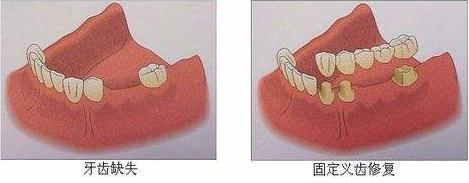 单颗牙缺失搭桥牢固吗,单颗槽牙缺失修复选用哪种方法好