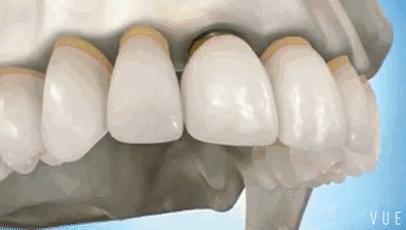 牙龈萎缩牙齿松动中医有什么方法,牙齿松动怎么办教你一招恢复