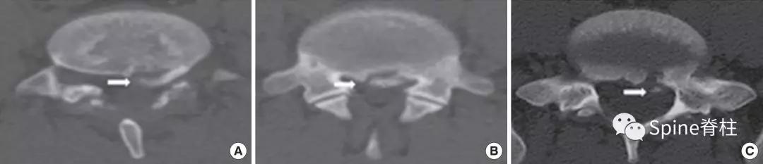 青少年一跑步就腰痛,青少年腰痛是什么原因引起的