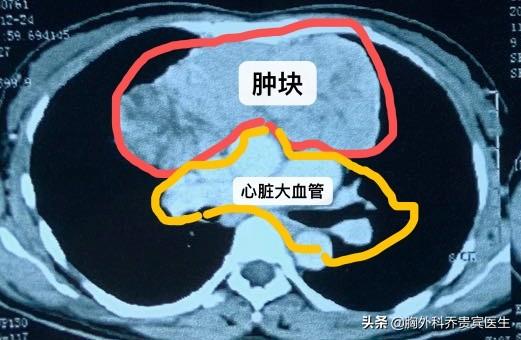 癌症心脏骤停,脑瘤病人什么原因导致心脏骤停