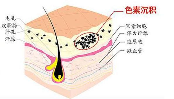 什么情况会让疤痕加重,不知道为啥现在成了疤痕体质