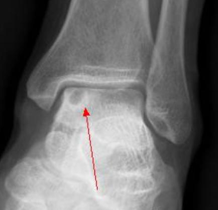 手腕出现小疙瘩越来越大,手腕突然长了一个小骨