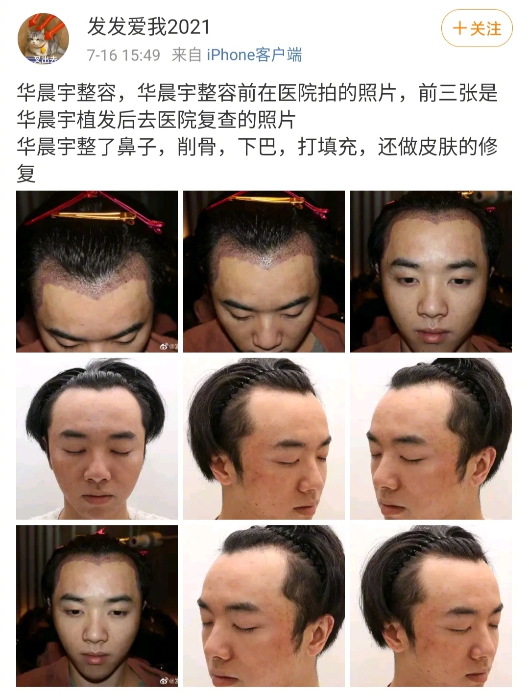 华晨宇回应植发,华晨宇澄清植发