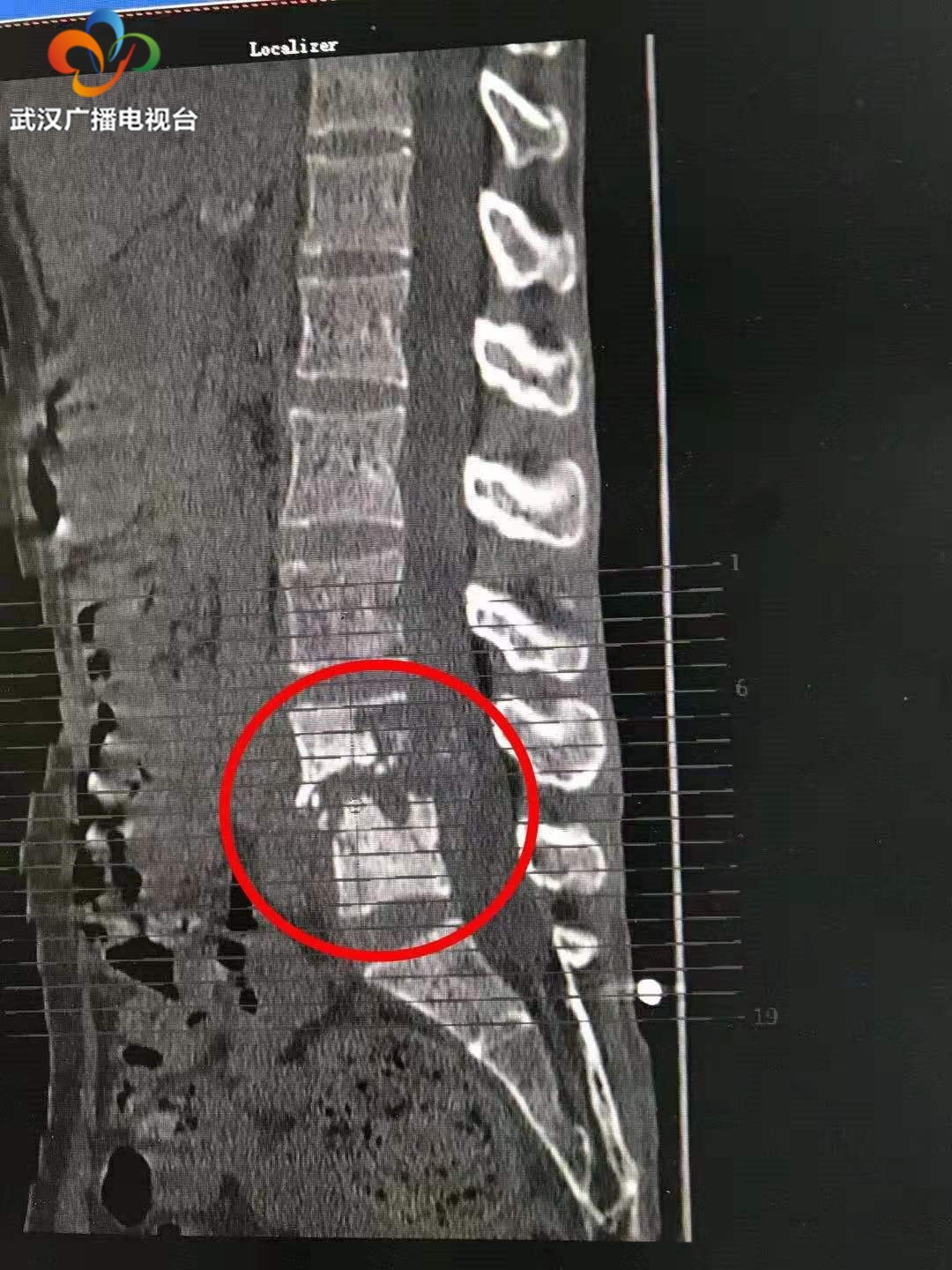 孩子得结核,宝宝无意间踢了妈妈一脚