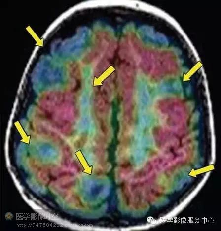 儿童癫痫CT表现,儿童各类癫痫脑电图特征