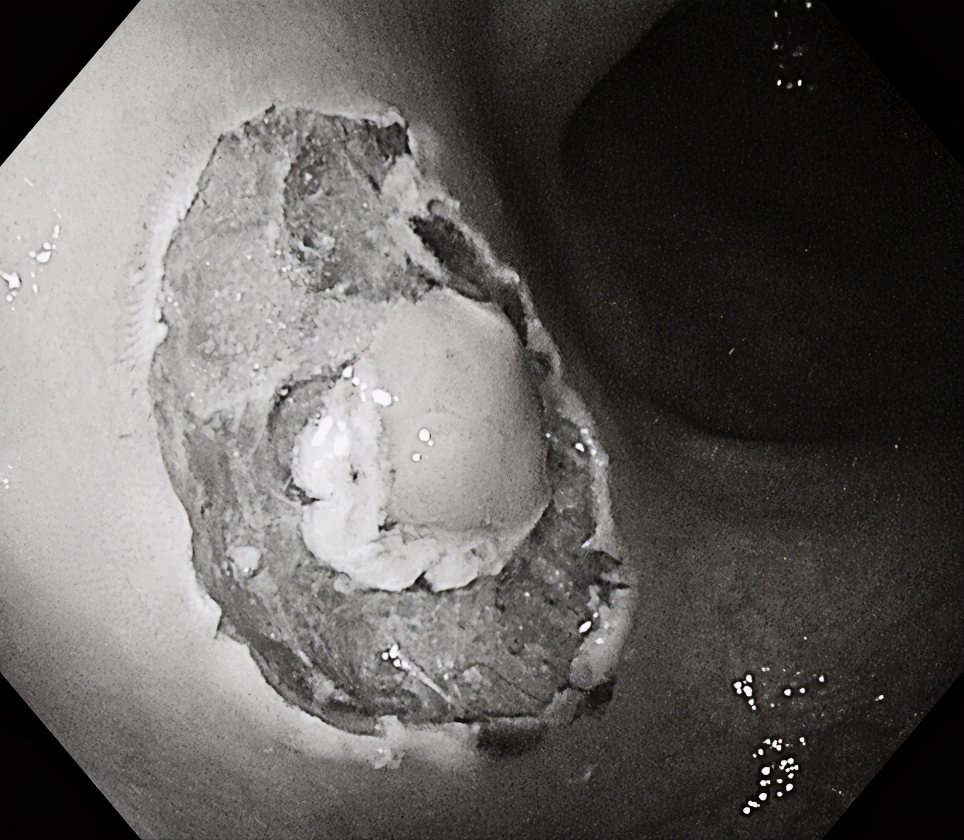 内镜黏膜下肿瘤剥离术,胃镜粘膜下肿瘤剥离术