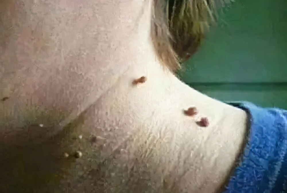 身上长了个小肉疙瘩怎么自己去除,身上长小肉疙瘩该怎么处理比较好