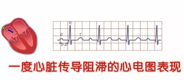 心律不齐需不需要过度治疗,心律不齐是否可以治愈