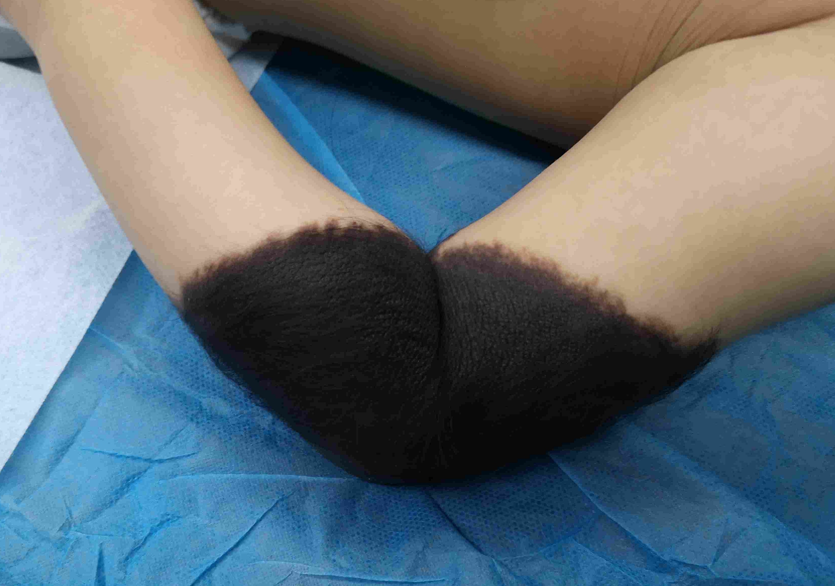 黑毛痣如何形成中医解释,专家告诉你黑毛痣的治疗最佳时间