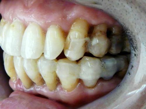 治疗它只要100多块，那为什么它却是口腔的“不治之症”？