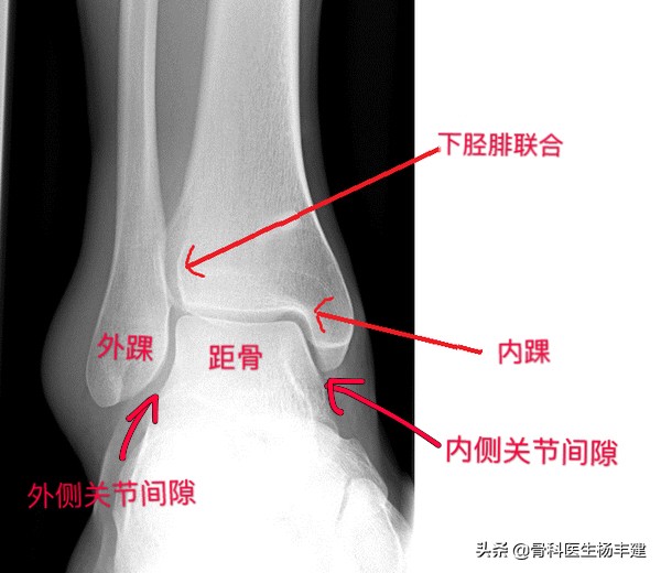 什么样的脚踝骨折适合保守治疗,什么样的腿骨骨折需要手术