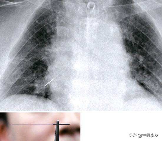 针灸学针刺的操作步骤和注意事项,学习针灸如何快速记住穴位