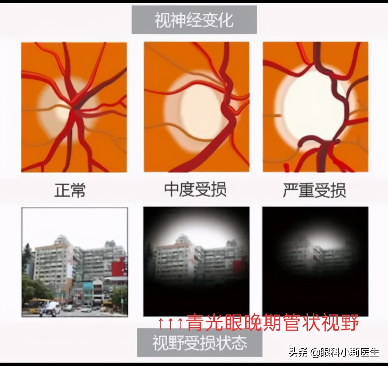 眼突眼胀耳鸣腰痛,眼胀畏光头痛怎么回事