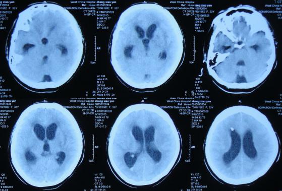 结核性脑积水,脑膜炎脑积水要治疗多久