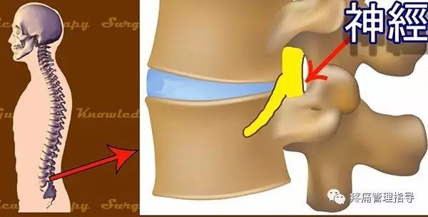 72岁老人腰疼还有骨刺该怎么治疗,老年人骨刺疼痛怎么治疗