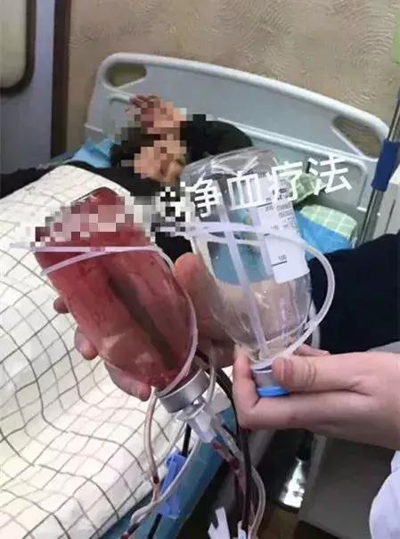 血液净化排毒有效果吗,血液净化排毒