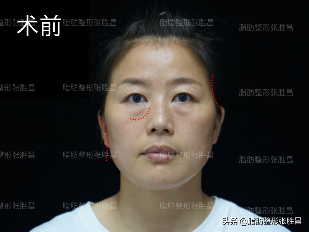 做脂肪填充面部以后变胖了,做脂肪面部填充会变美吗