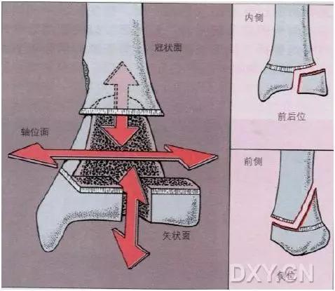 几种严重骨折医学名称,常见的骨折有哪些名称