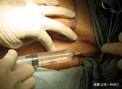 泰国人妖是变性手术还是打激素,泰国人妖变女性要经过哪些手术