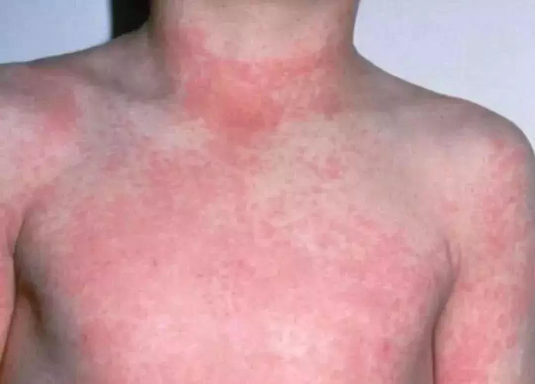 看图说病！专家提醒：立春后娃最易感染6种疹子，一定要认准了治