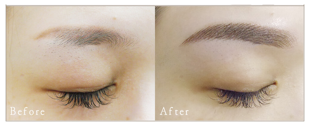 激光洗红眉的操作方法视频,红眉能激光吗