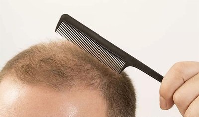 脱发头发不长什么原因,青少年脱发怎么防止掉发