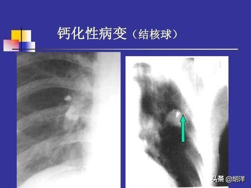 人体用浇灌“水泥”的方法封闭结核菌,只有这样才能算完全痊愈