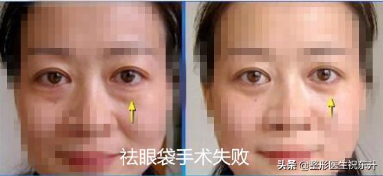 做眼袋手术的费用，听说中年人比年轻人要偏贵？有了解的谈一谈