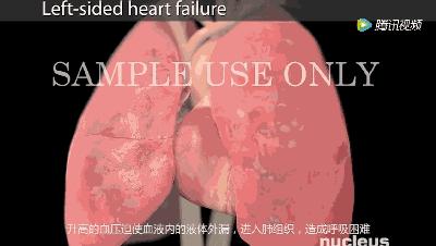 支架后病人还能活多久,支架手术后恢复锻炼分几级