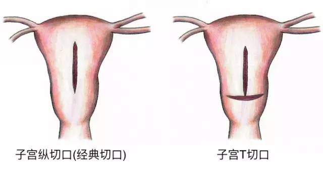 一胎剖腹产了二胎可以顺生吗,剖了一胎第二胎可以顺产吗