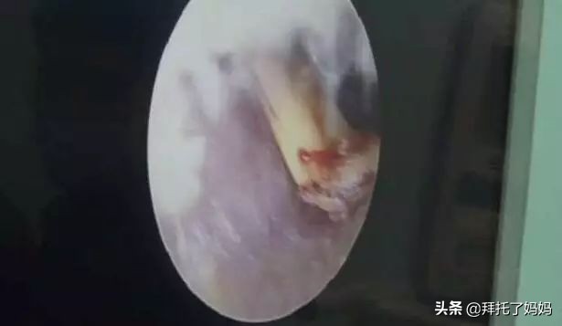 小孩长期不挖耳屎的危害,男童4年没有挖耳屎