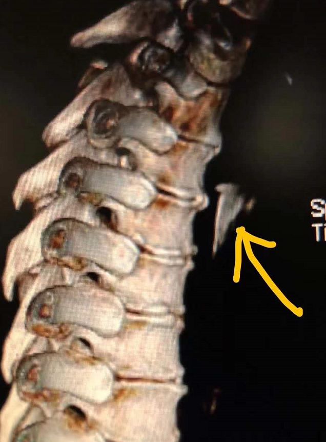 南宁男子吃到鱼刺竟强行吞下,男子吃饭误吞鱼刺