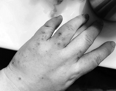 妊娠纹发痒有小红疙瘩,孕期妊娠纹瘙痒与胆汁酸高的区别