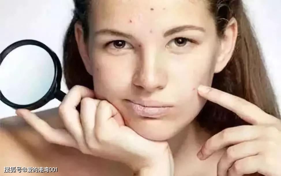 怎样祛痘印最有效的方法,如何快速祛痘祛痘印小妙招