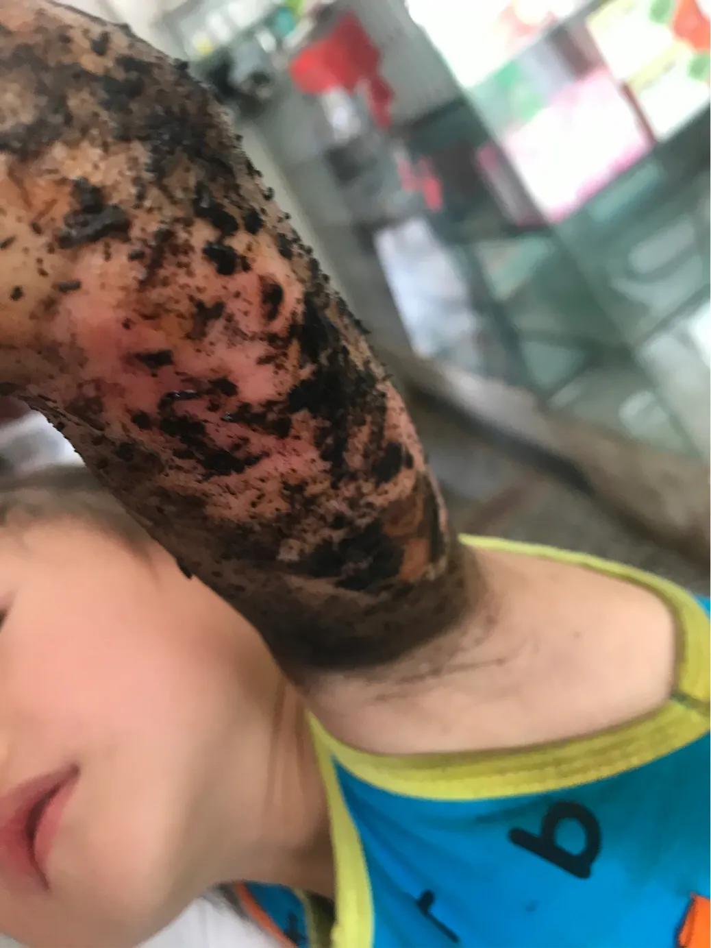 孩子大面积烫伤治疗流程,记录女儿被烫伤到治疗全过程