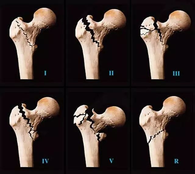 髋关节疼有哪几种原因,髋关节痛如何能确诊什么原因引起