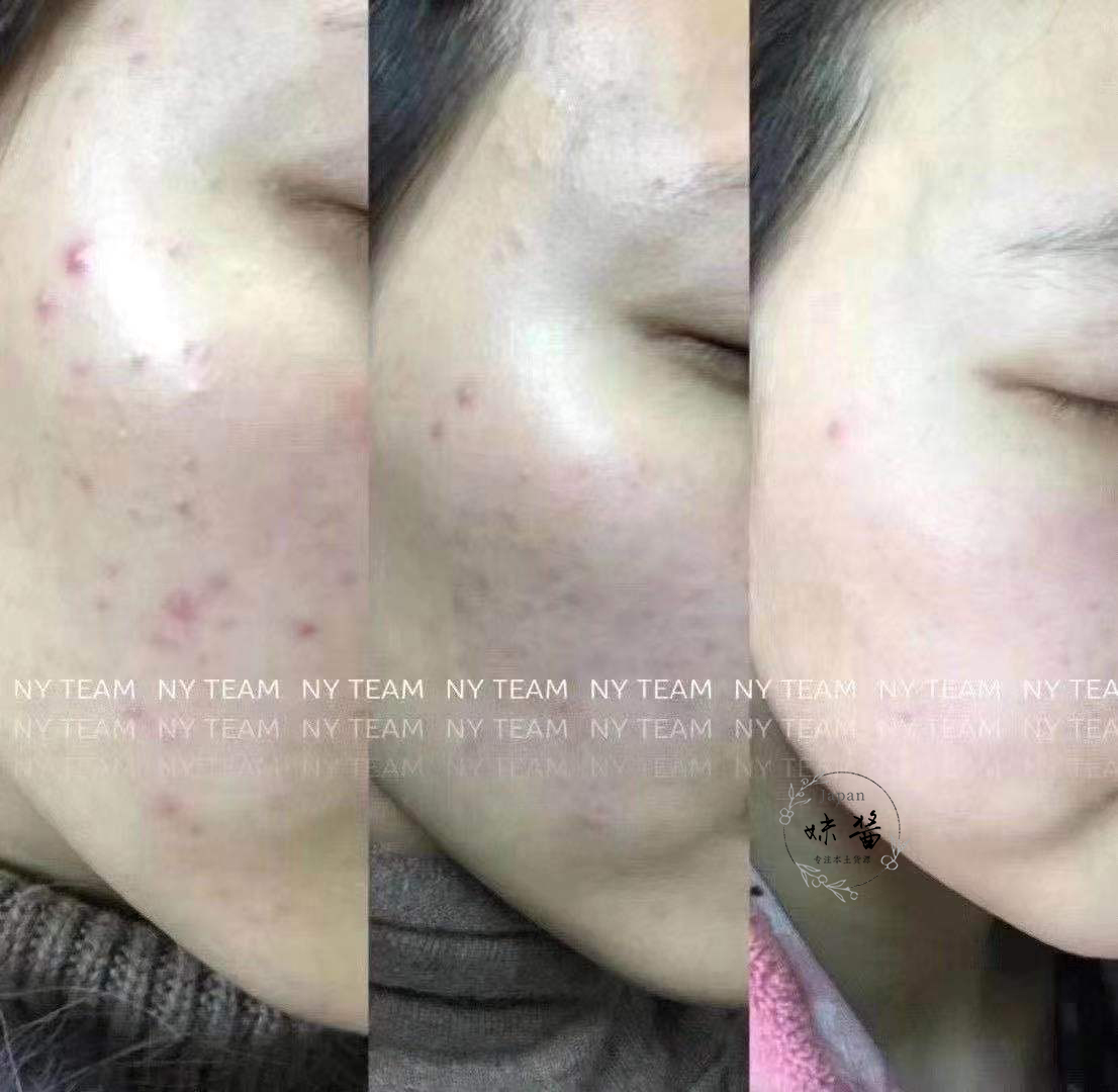 #养肤记#可以让干敏痘皮养成健康中性皮的终极产品分享