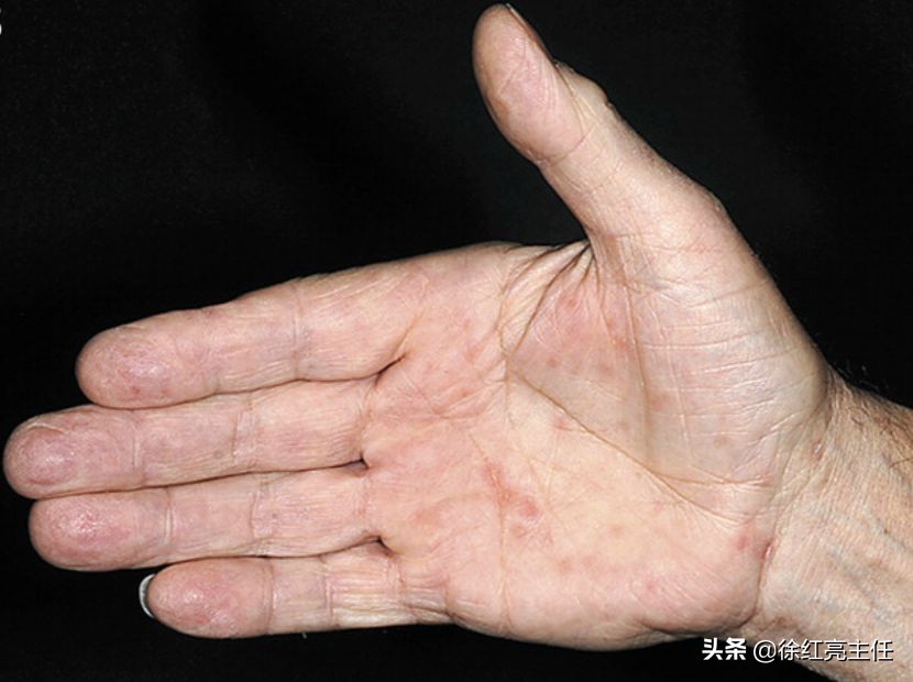 手掌脚掌红疹是梅毒吗,手掌唯一一个红疹会是梅毒吗