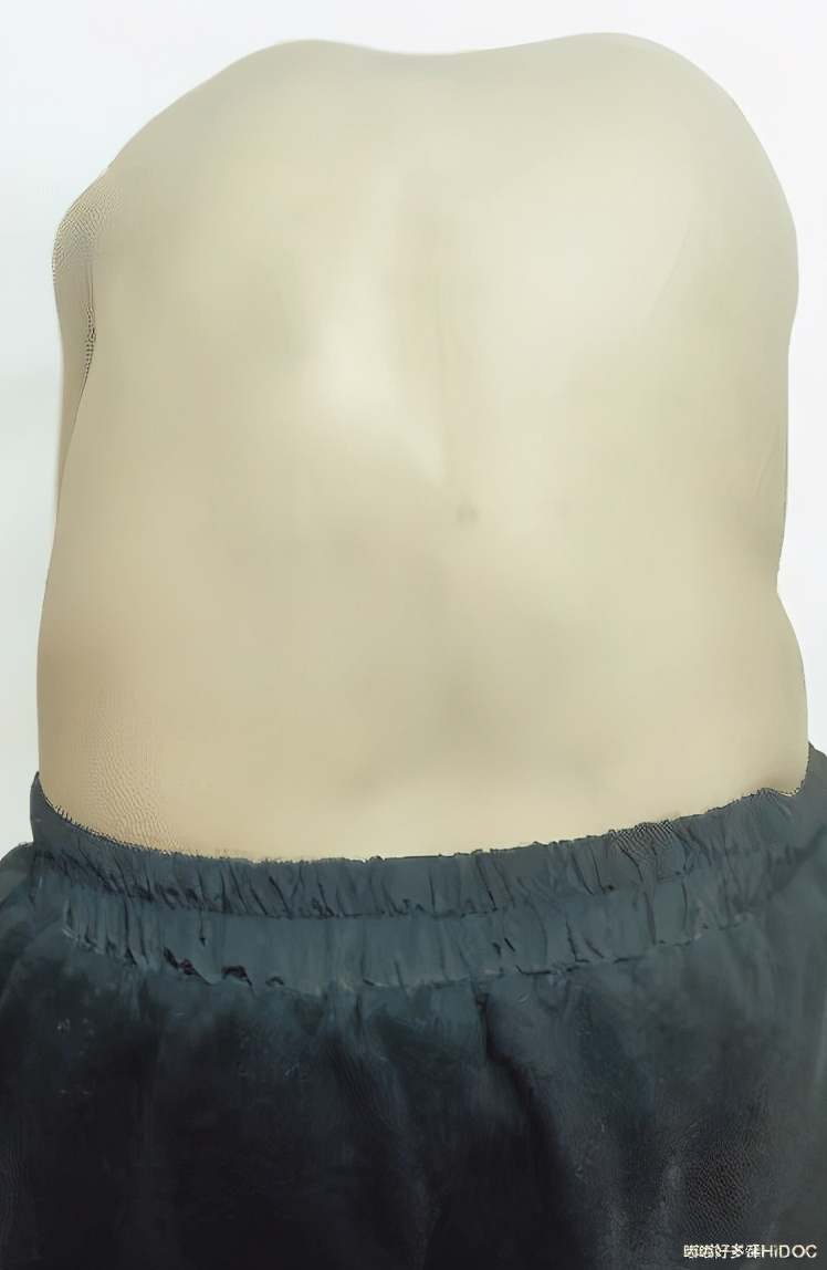 儿童颈椎侧弯会有什么后果,13岁孩子颈椎侧弯矫正睡姿图片