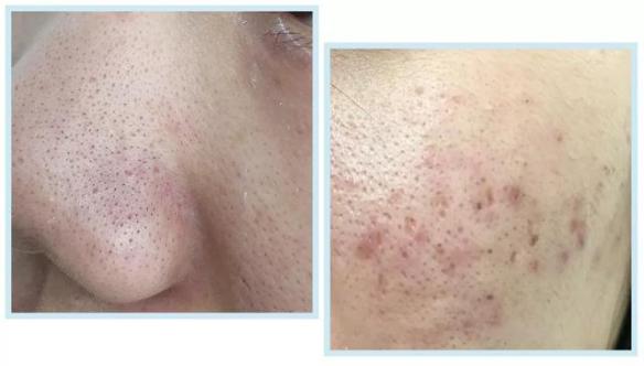 喷雾式的去黑头的东西,去黑头收缩毛孔吸黑头神器测评