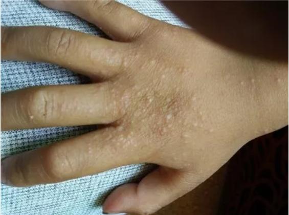 孩子去海边回来过敏什么原因,宝宝去海边玩长一片一片的疹子