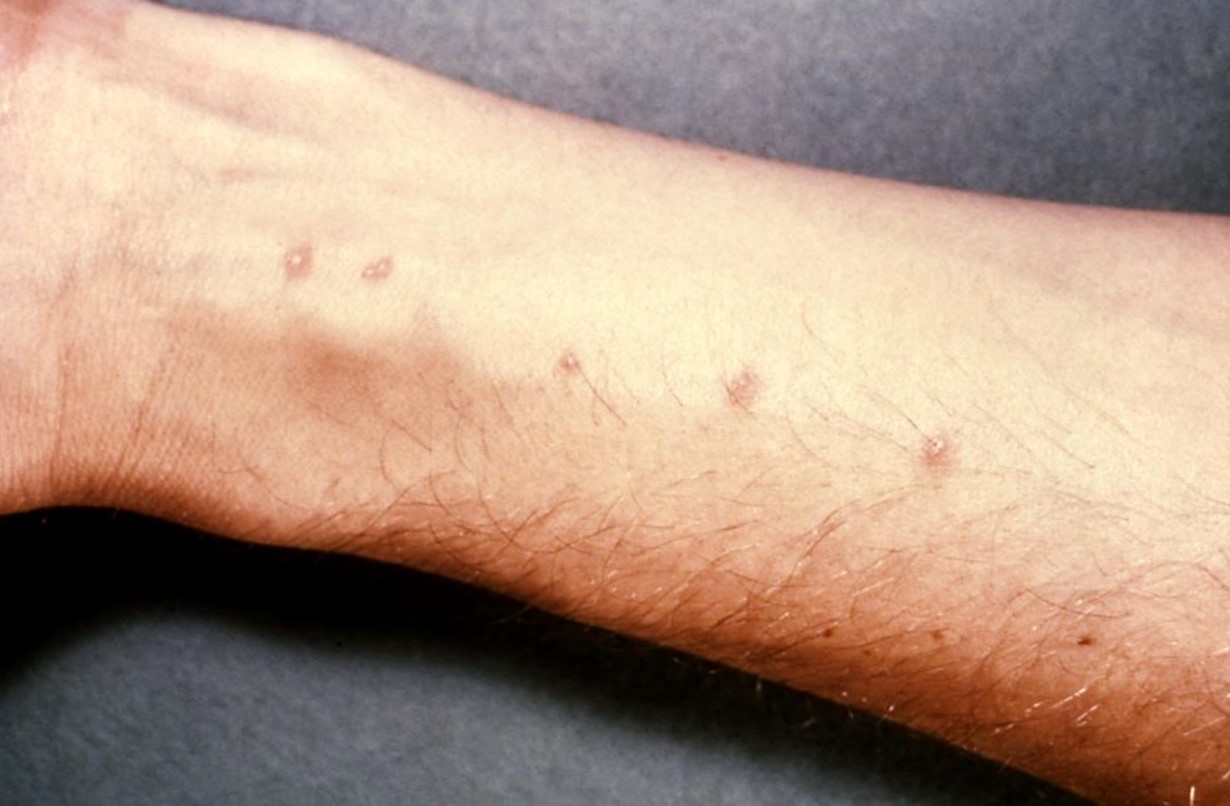 可以在人体寄生的海洋寄生虫,血吸虫寄生人体雌虫多久会产卵