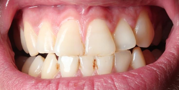 口腔牙龈肿痛怎么根治,牙龈肿痛是大病前兆