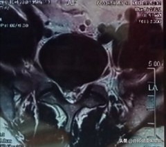 腰椎间盘突出病因的中医解释,腰椎l5s1椎间盘突出症的自我疗法